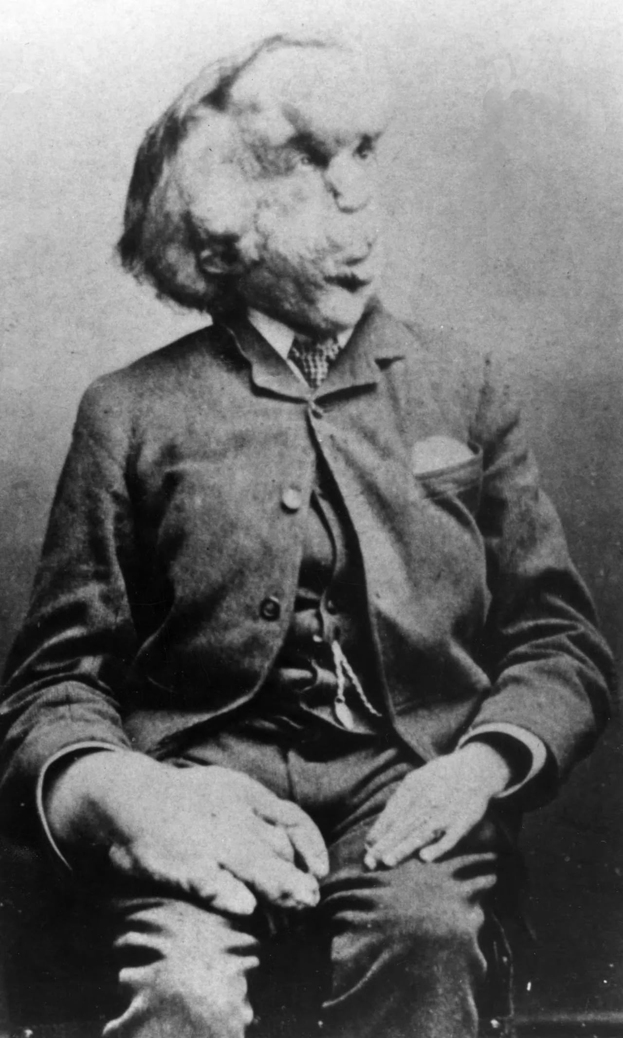 Porträt von Joseph Merrick (1862–1890) – Gedenkseite